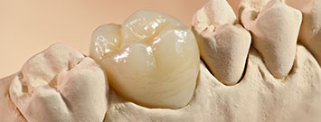 半永久的に白く美しい歯へ