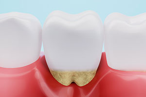 マイクロスコープでの歯周病の治療
