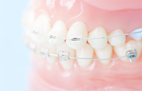 理想の歯並びを実現するため、無償でワイヤー矯正を併用します